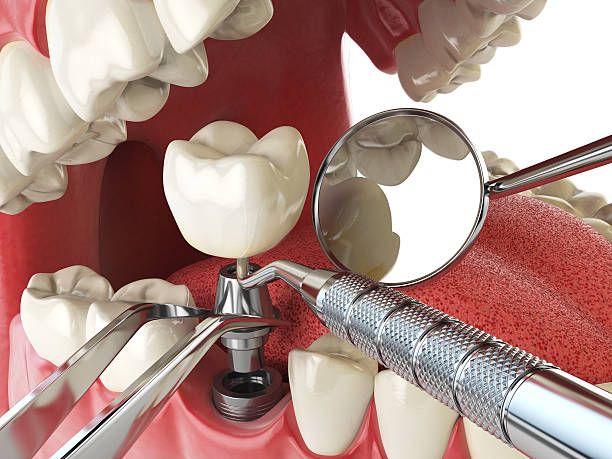 Best Emergency Tooth Extraction in Sullivan, MO